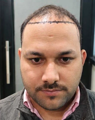Patient 1 before treatment, front view