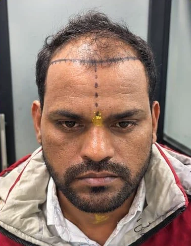 Patient 3 before treatment, front view