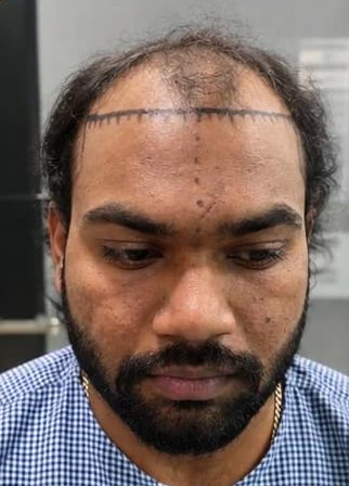 Patient 5 before treatment, front view