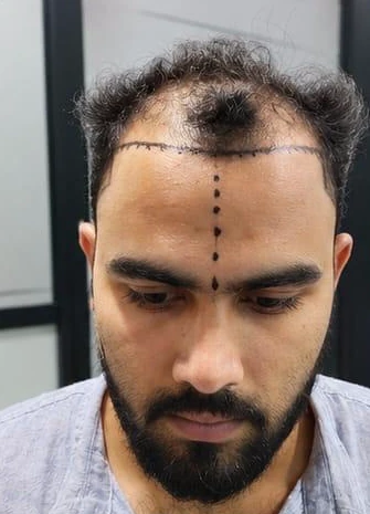 Patient 6 before treatment, front view