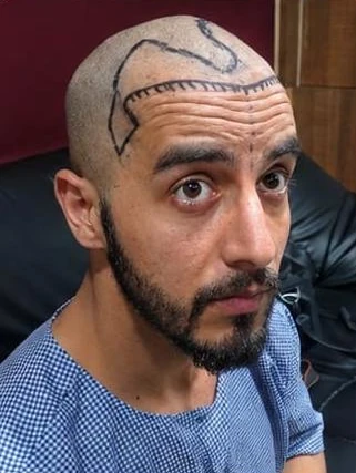 Patient 9 before treatment