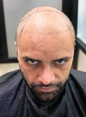 Patient 11 before treatment