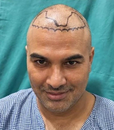 Patient 13 before treatment
