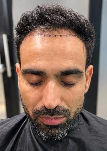Patient 14 before treatment