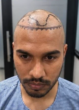 Patient 15 before treatment