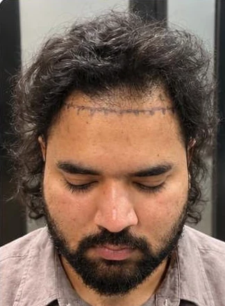 Patient 17 before treatment