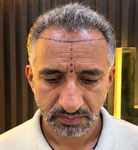 Patient 18 before treatment